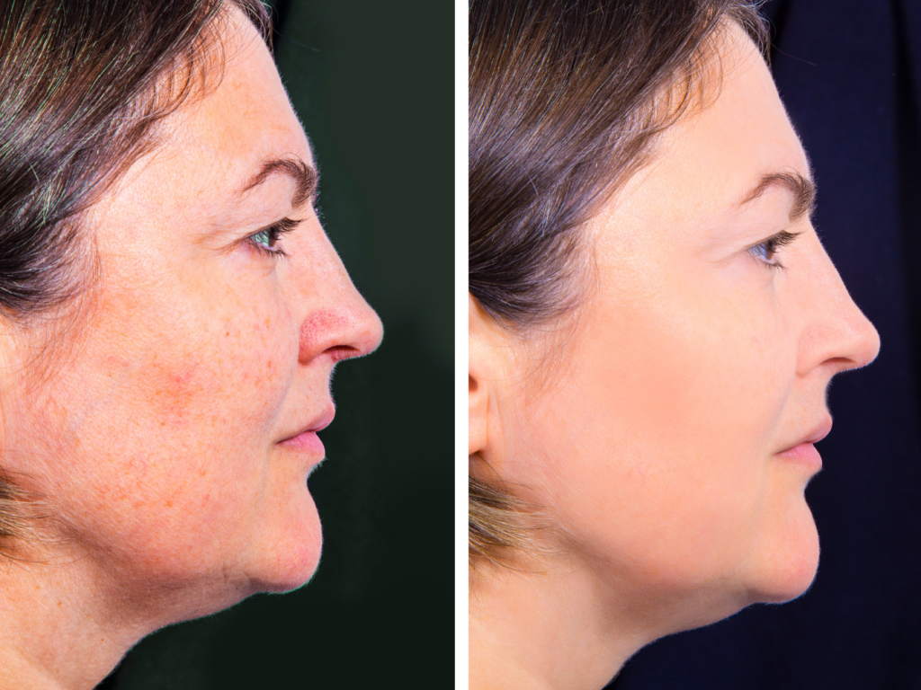 Hyperpigmentation cleared up with Cryotherapy - fife glenrothes